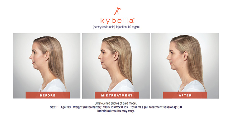 Kybella Antes y después de