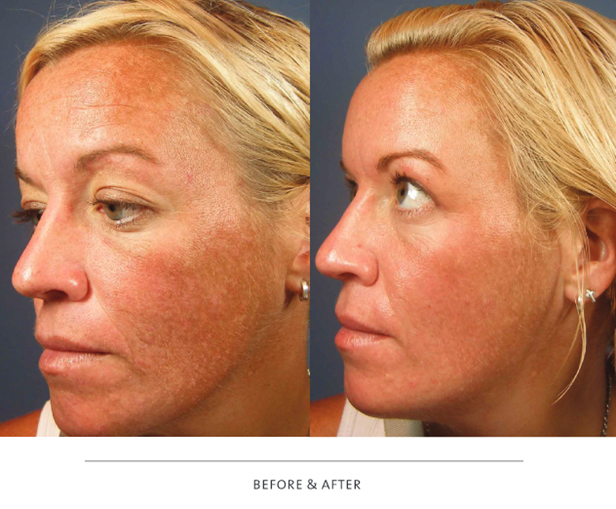 VI Peel - PRECISION Before & After