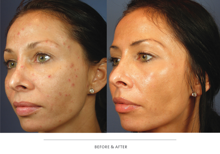 VI Peel - PURIFYING Before & After