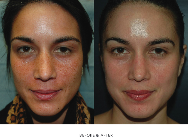 VI Peel - PRECISION PLUS Before & After
