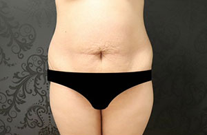 Mini tummy tuck