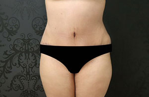 tummy tuck before & after